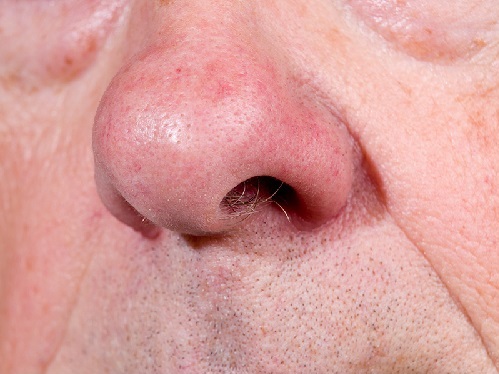 parkinsons disease olfactory dysfunction